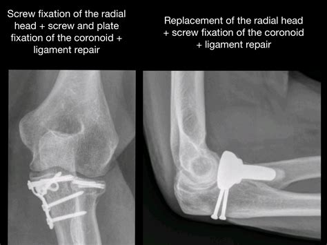 Elbow Terrible Triad ORIF .